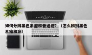 如何分辨黑色素瘤和普通痣？（怎么辨别黑色素瘤和痣）