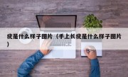 疣是什么样子图片（手上长疣是什么样子图片）